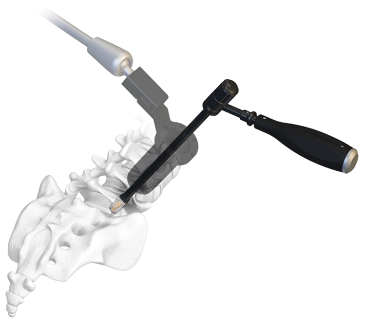 Lucent MIS TLIF Posterior Access System Spinal Elements