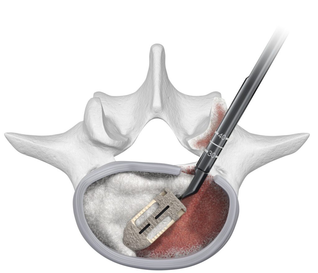 TeleGraft Demineralized Bone Matrix Fiber Putty Biologic Spinal Elements