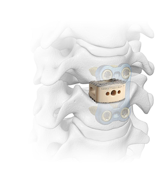Crystal TiBond Cervical Interbody System Spinal Elements