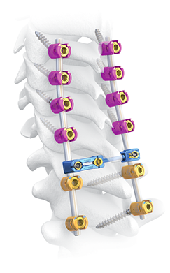 Lotus Posterior Cervical Thoracic Fixation System Spinal Elements