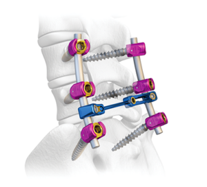 Spinal Fixation Devices | Thoracolumbar Fixation Products