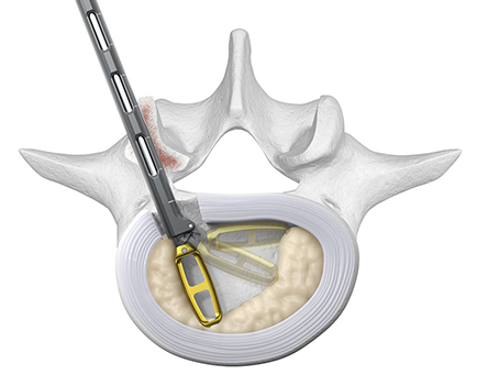 Spinal Instrumentation 