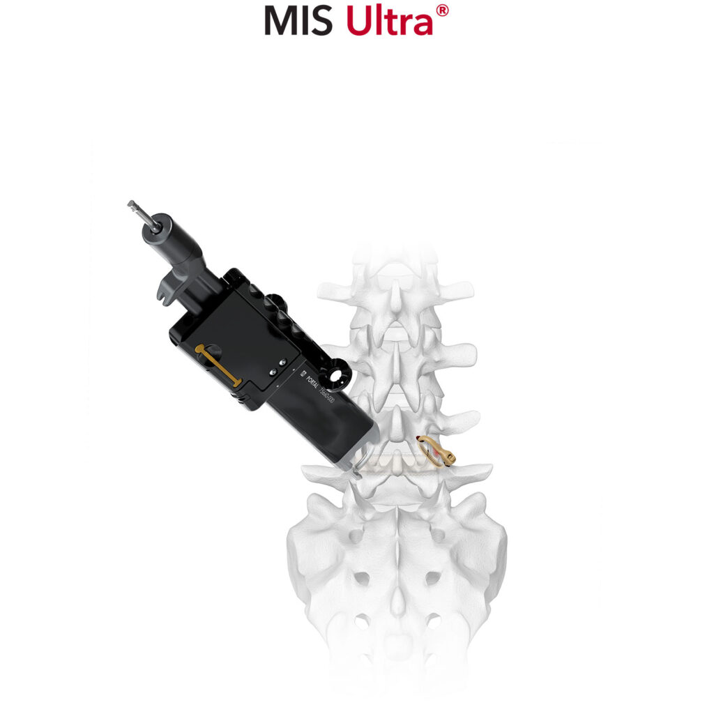 Karma MIS Ultra Non-metal spinal fixation Thoracolumbar Spinal Elements