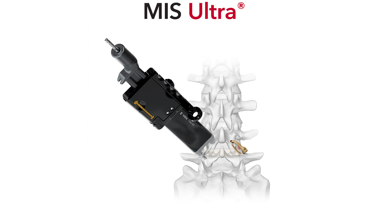 Karma MIS Ultra Non-metal spinal fixation Thoracolumbar Spinal Elements