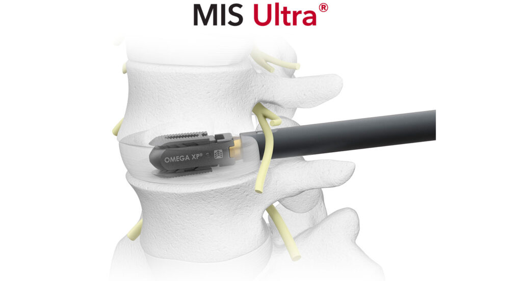 Omega XP MIS Ultra expandable lumbar interbody Thoracolumbar Spinal Elements