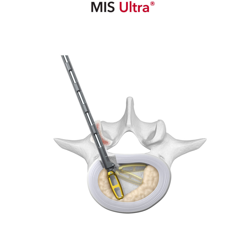 Orbit MIS Ultra Articulating Rotating Discectomy Instrument Thoracolumbar Spinal Elements
