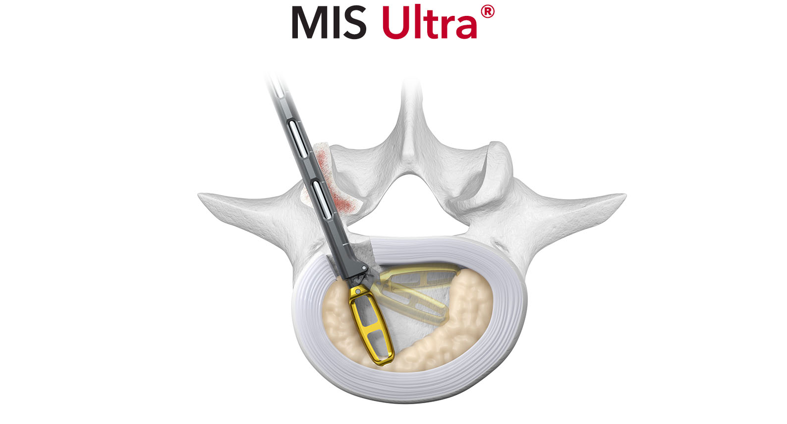 Orbit MIS Ultra Articulating Rotating Discectomy Instrument Thoracolumbar Spinal Elements
