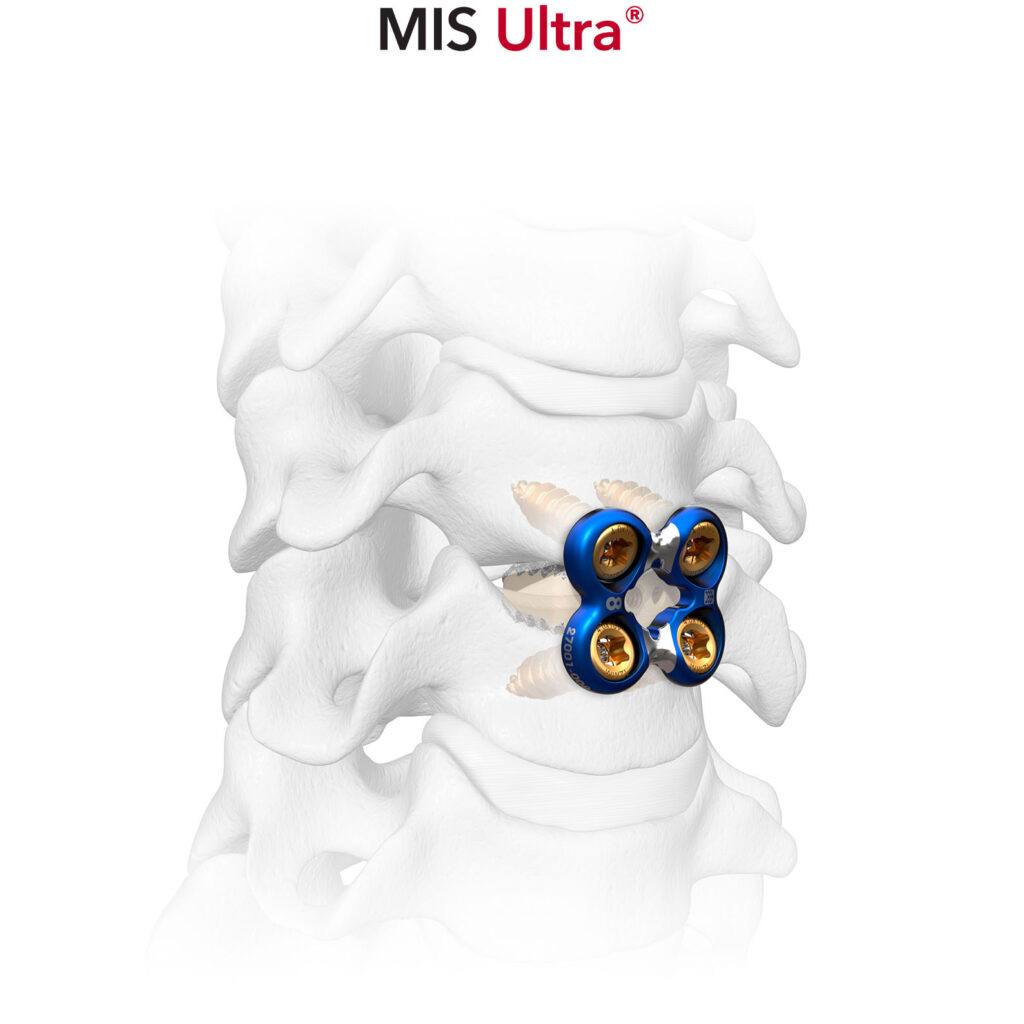 MIS Ultra - Sapphire X Cervical Plate System Spinal Elements