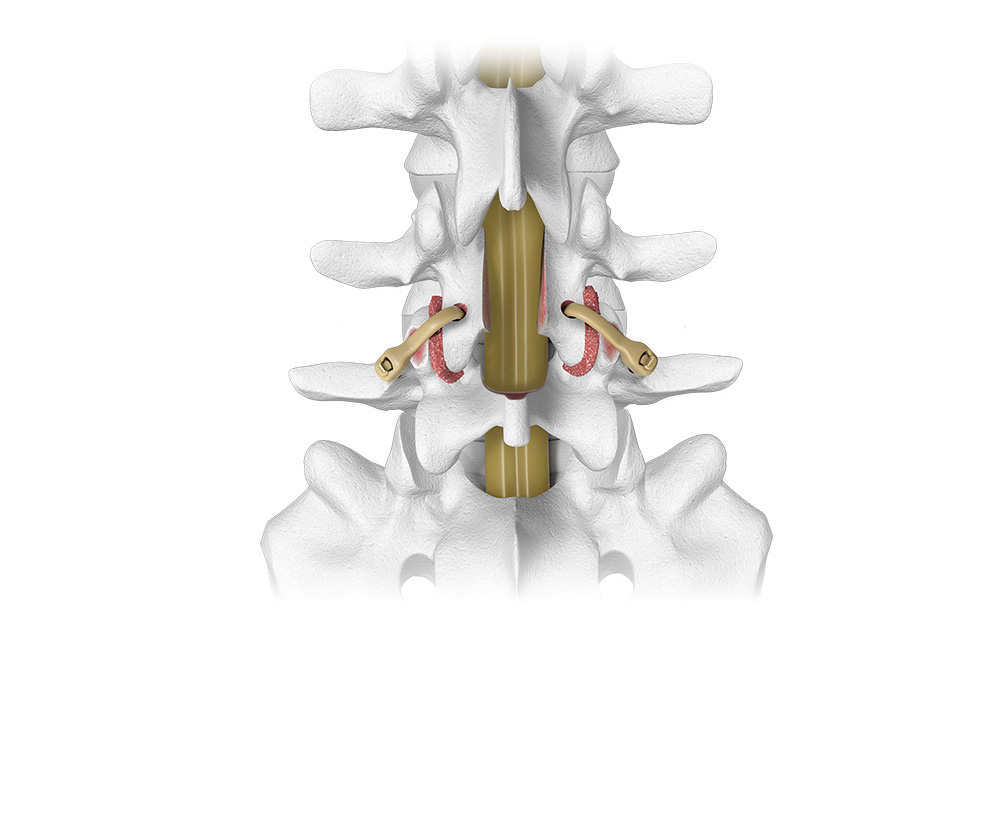 Karma An Aging Spine, Metal-Free Fixation Solution