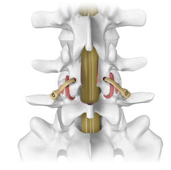 Karma-laminectomy-spondylolisthesis-cortico-pedicular-spine-fixation-system-by-Spinal-Elements_sm