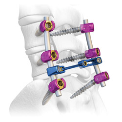 Mercury Thoracolumbar Spinal Fixation System