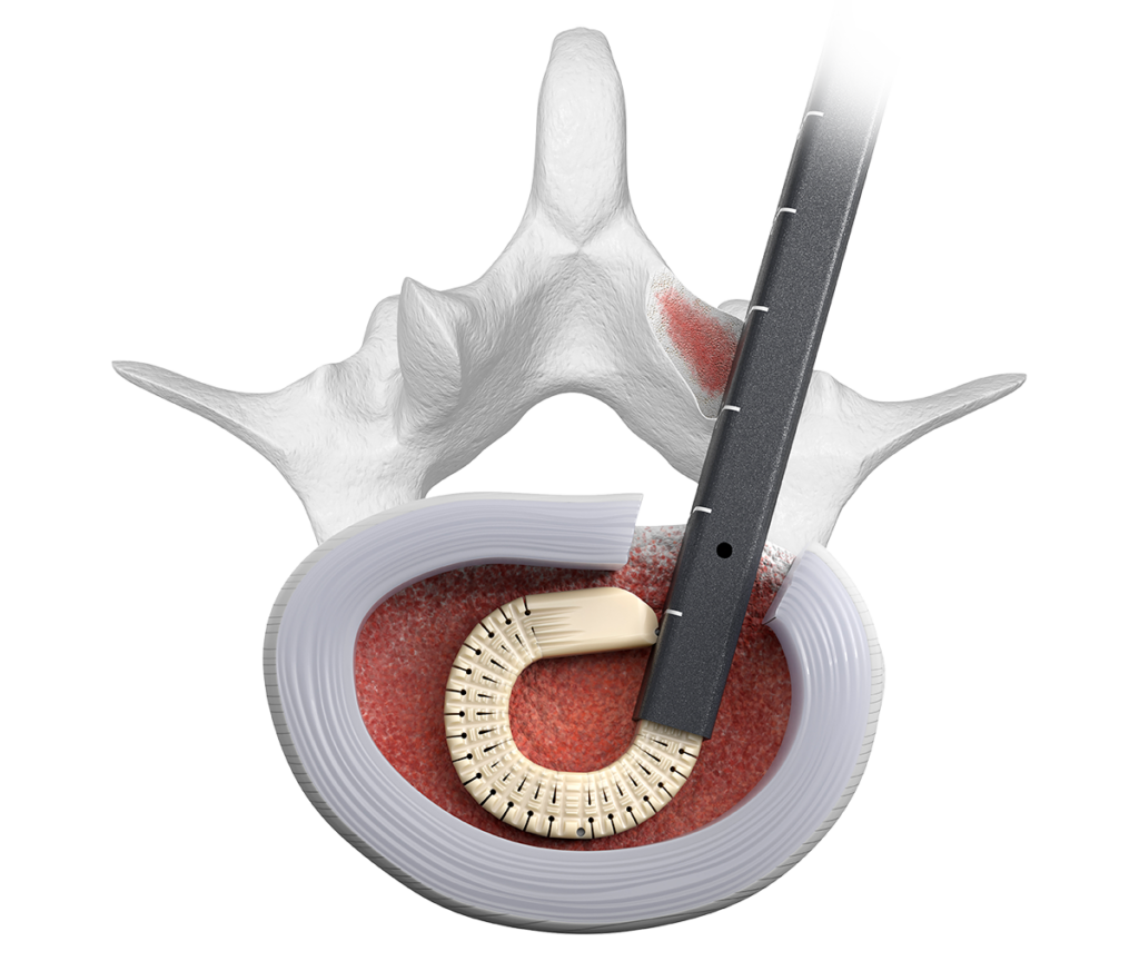 Luna TLIF expandable spinal implant_spinal elements