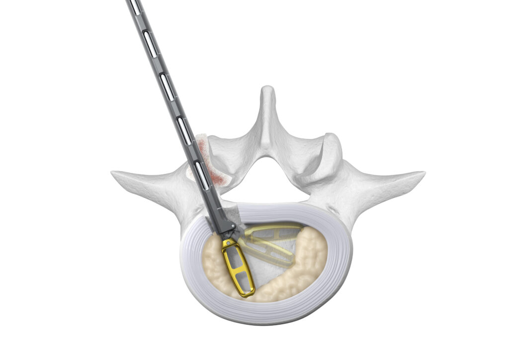 Orbit Articulating Rotating Discectomy Instruments_Spinal Elements