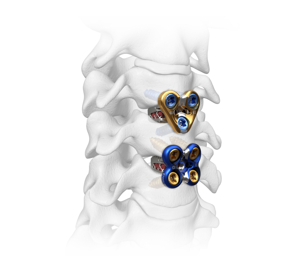 Sapphire X Cervical Spine Plating System_Spinal Elements