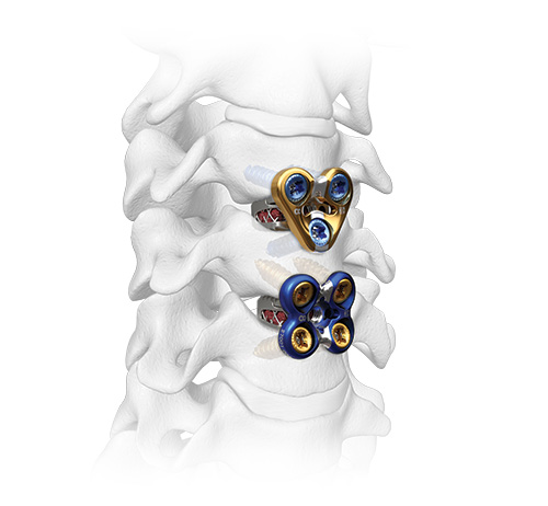 Sapphire X 2 level construct 4 and 3 hole_Feature