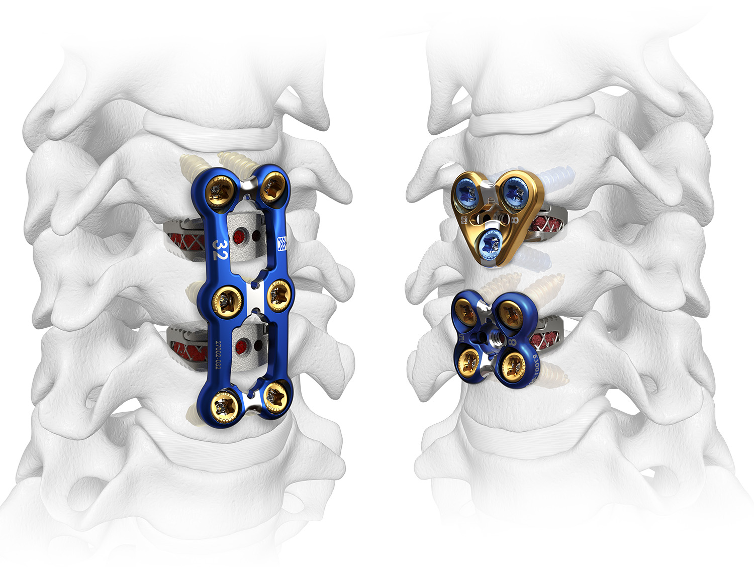 Sapphire X Single & Multi-level ACDF Cervical Spine Fixation Plate