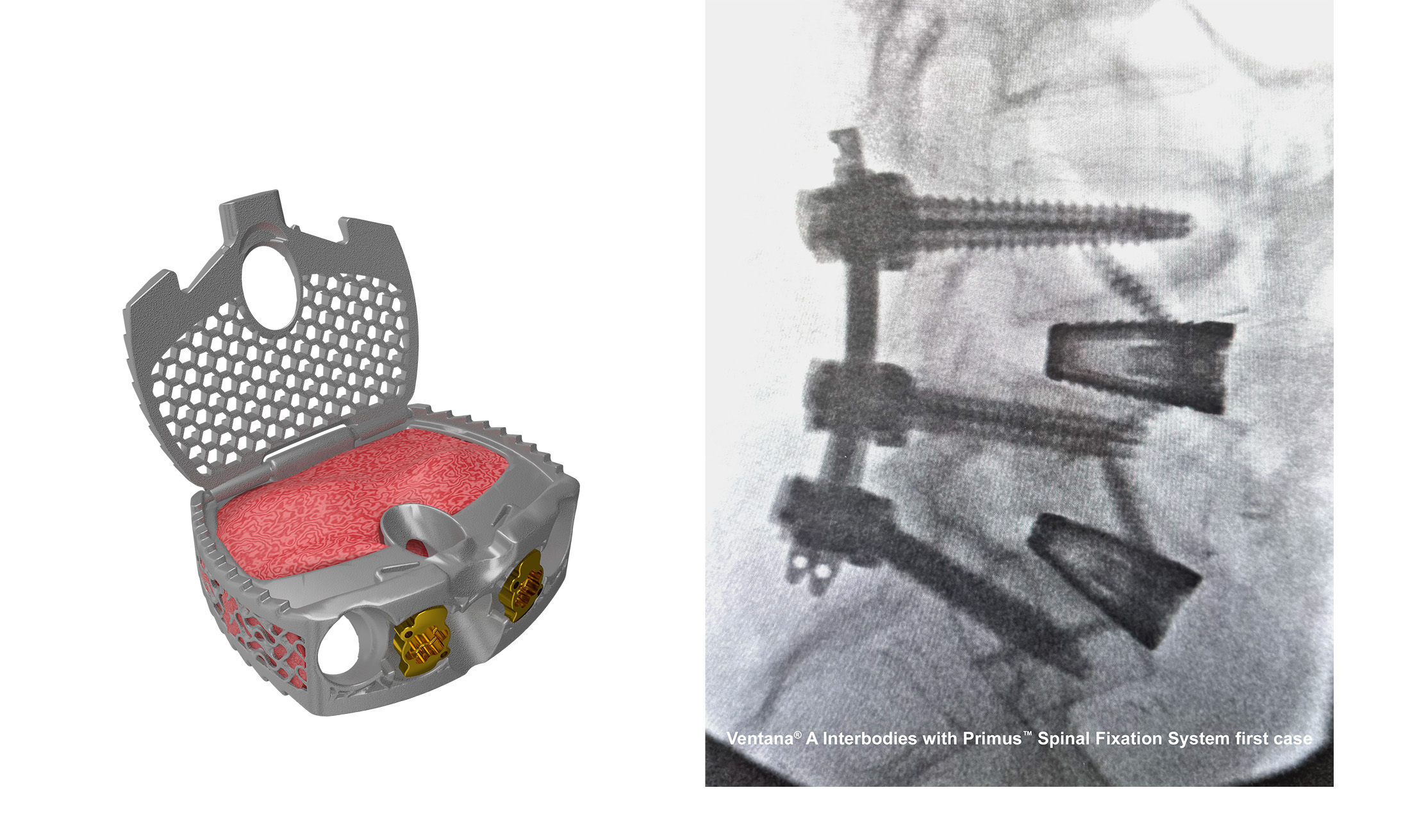 Ventana A ALIF spinal implant_Spinal Elements