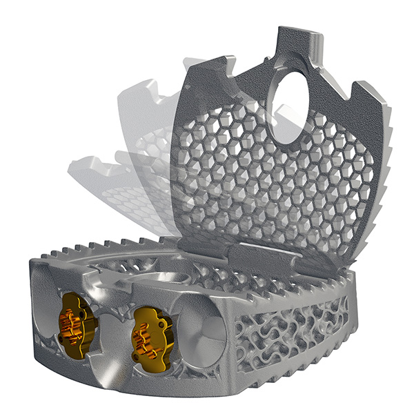 Ventana A Lid Opening_ALIF Interbody_Spinal Elements