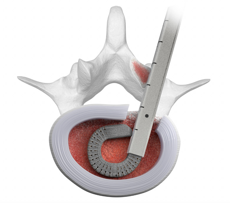 Luna Ti MIS lumbar spinal implant_15 degree